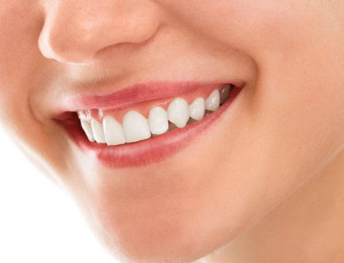  Sept raisons de recourir au blanchiment dentaire Bondues !
